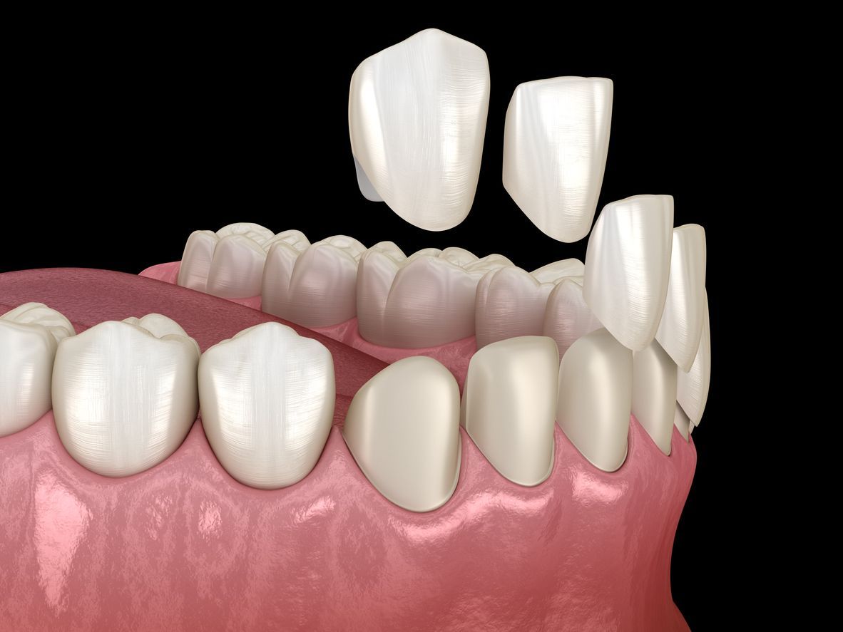 Porcelain veneer treatment