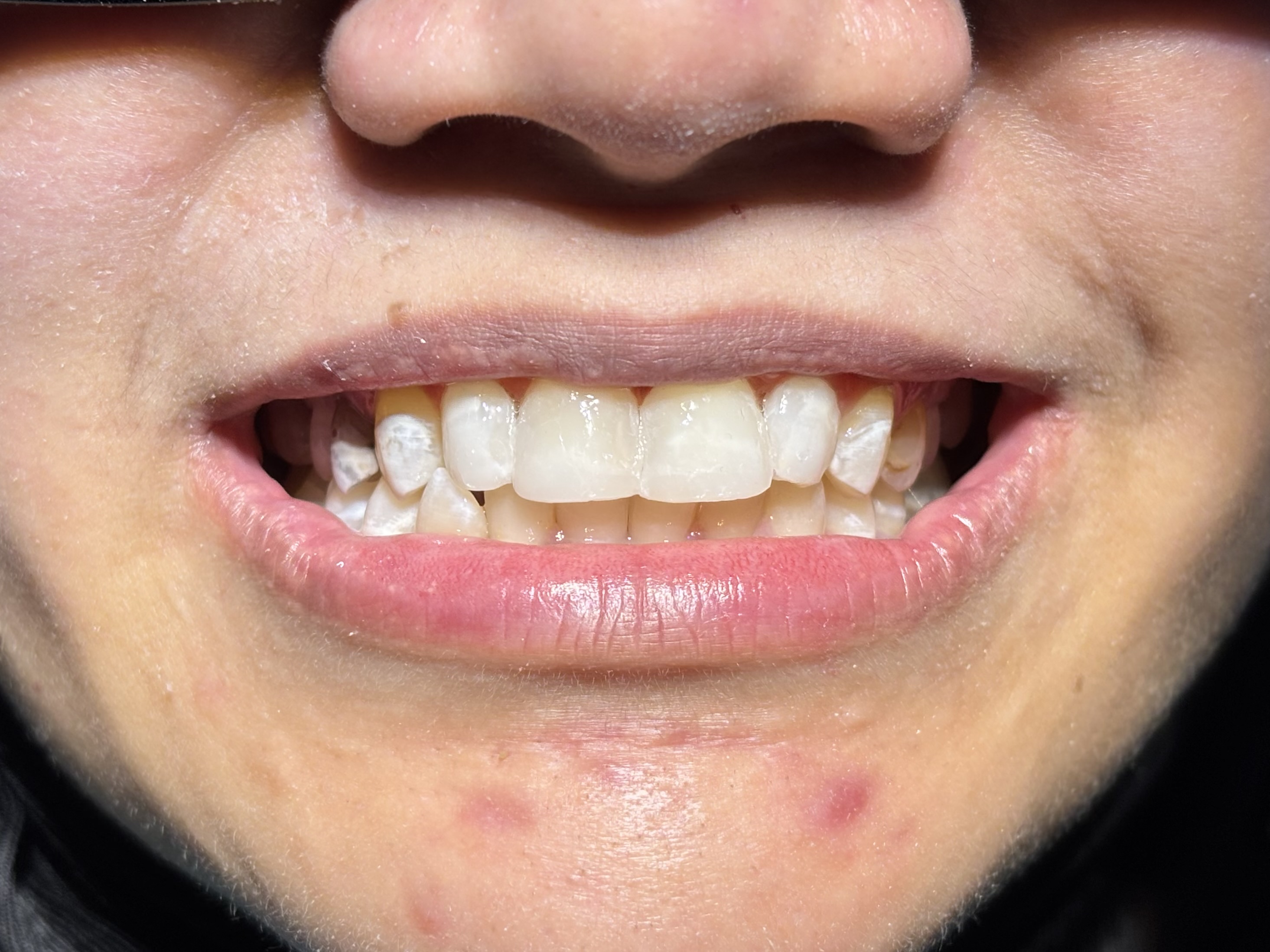 After - Veneer