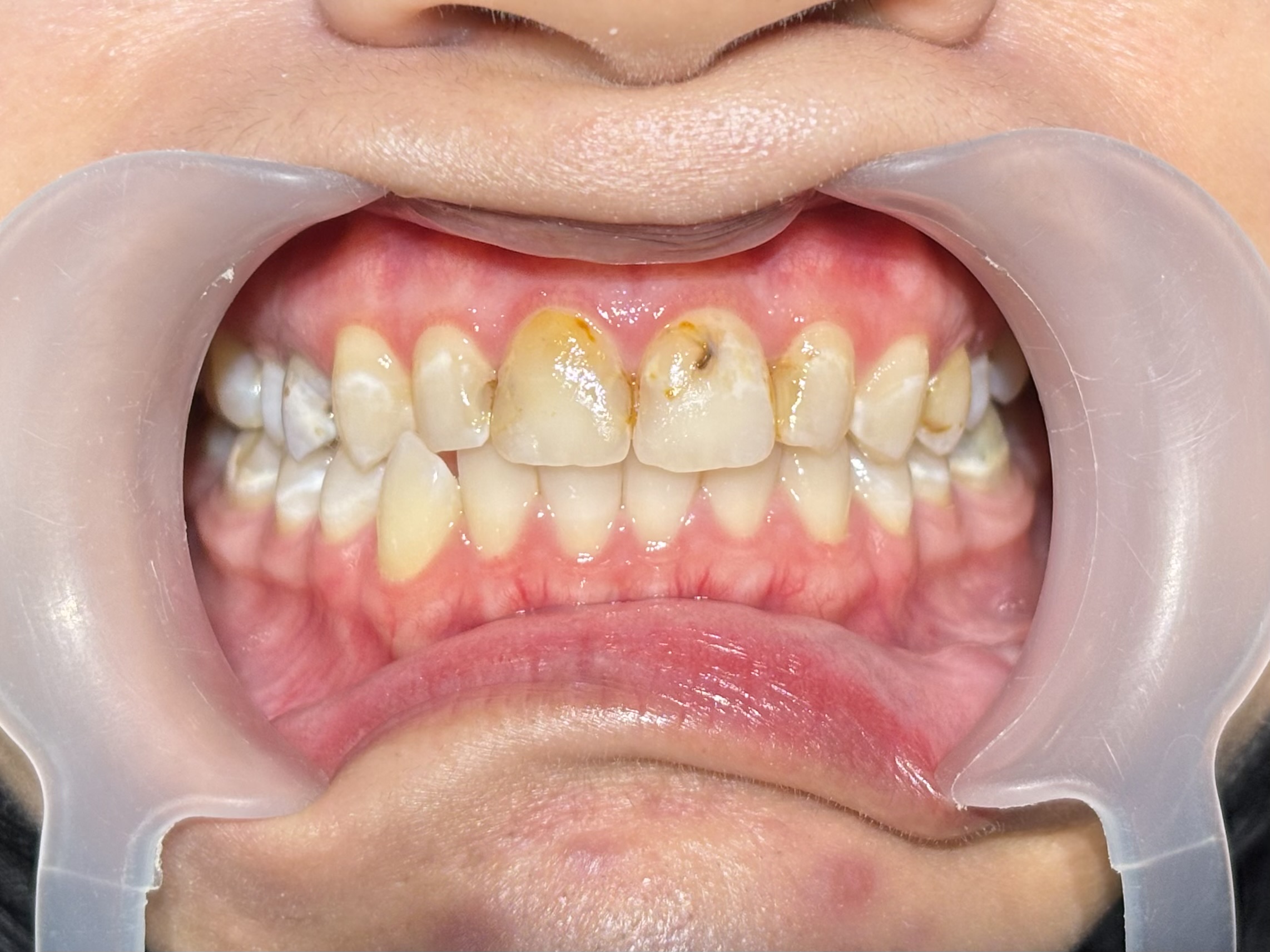 Before - Veneer