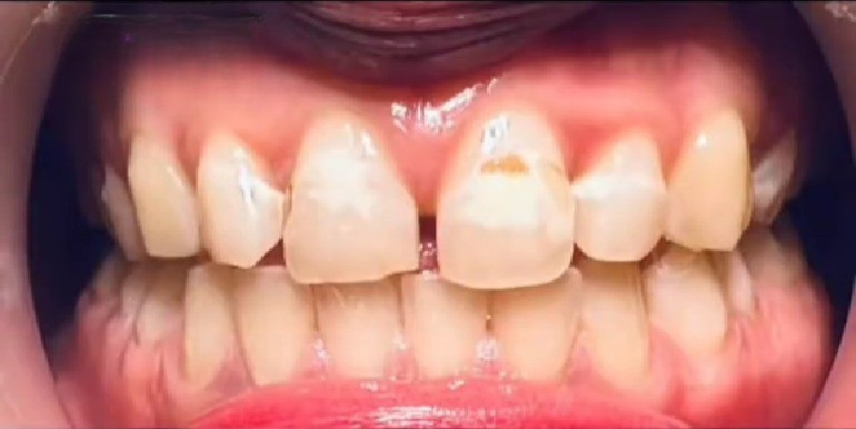 Before - Veneer
